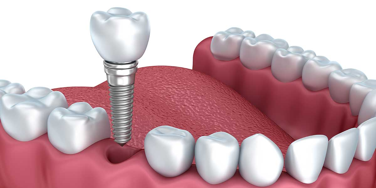 A Single Tooth Implant Replacement Filling the Gap of Missing Teeth on an Artificial Jaw
