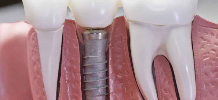 A Picture Showing Single Tooth Implant Replacement on an Artificial Jaw