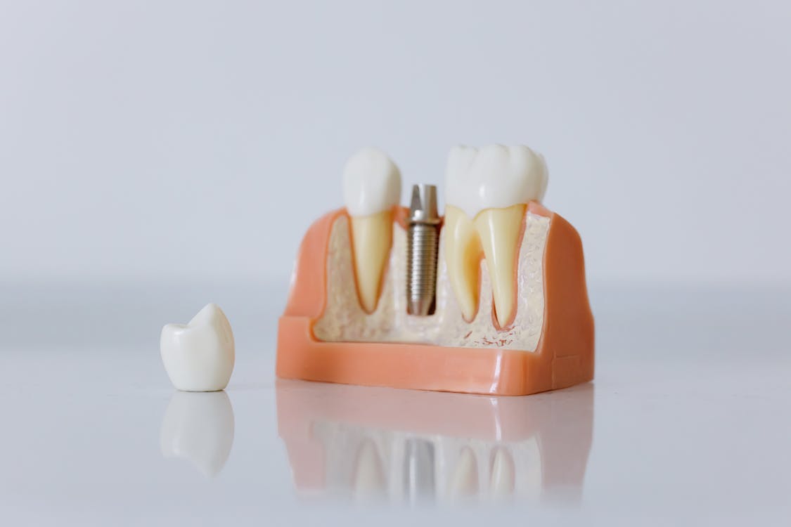 A Fake Jaw Showing Titanium Post Required for a Fixed Implant Tooth Bridge