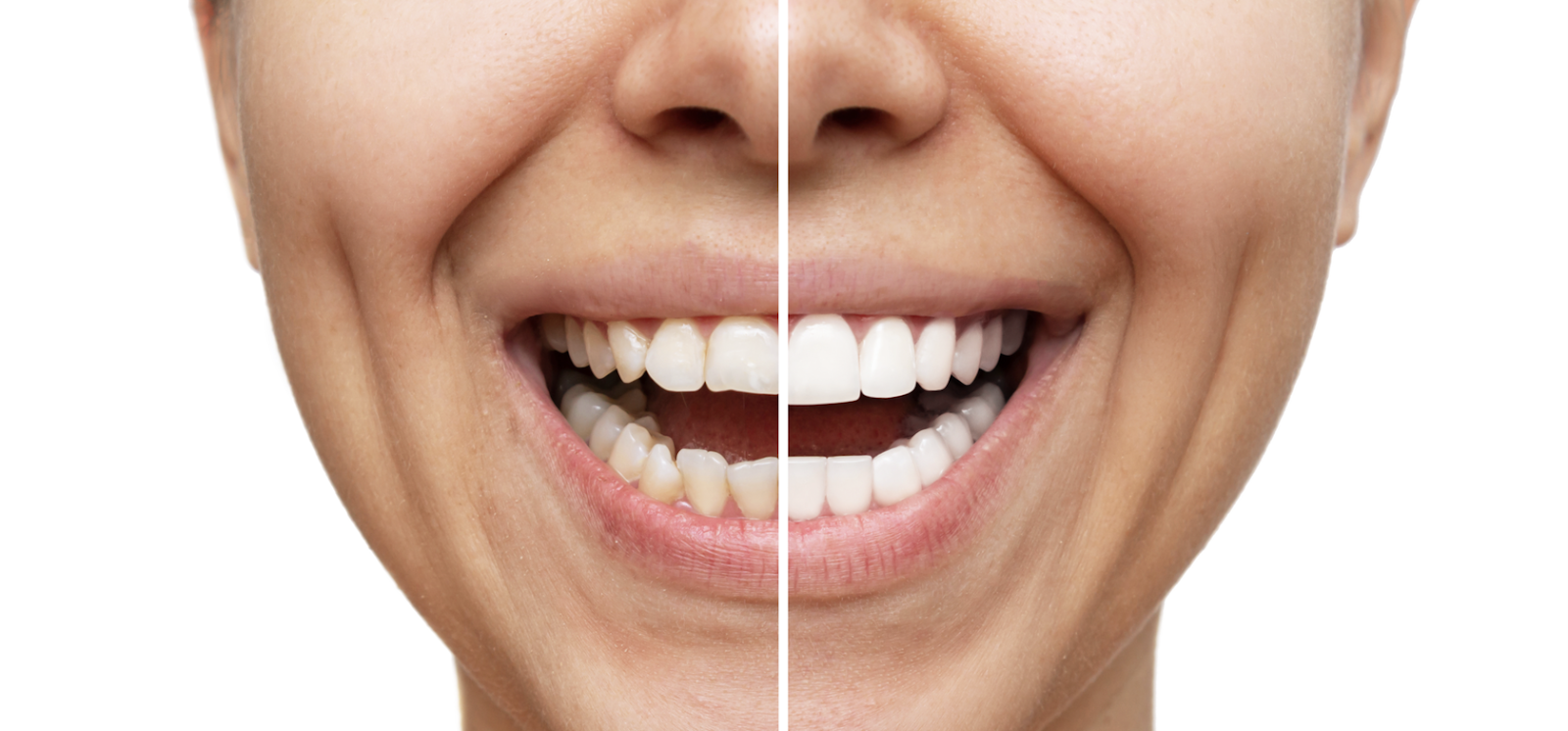 Before Restoration Dental and After Restorative Dentistry With All on 4 Dental Implants.