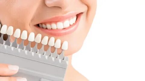 A Bright Smile of a Woman After Receiving All on 4 implants for Dental Restoration.