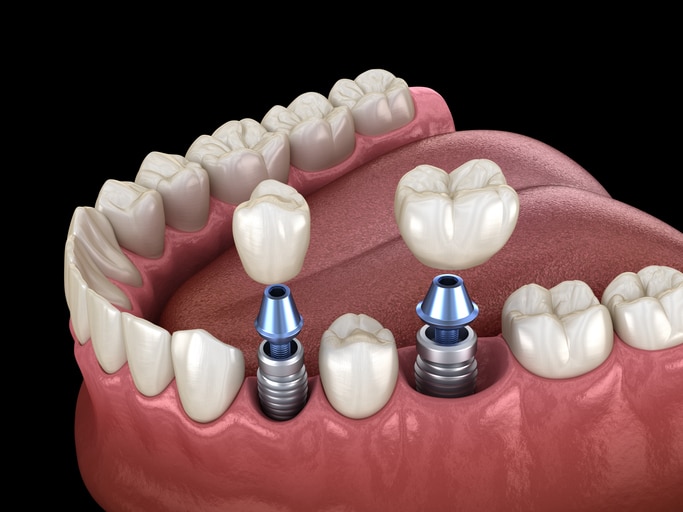 A Mini Dental Implant Showing How the Crown Fits the Abutment.