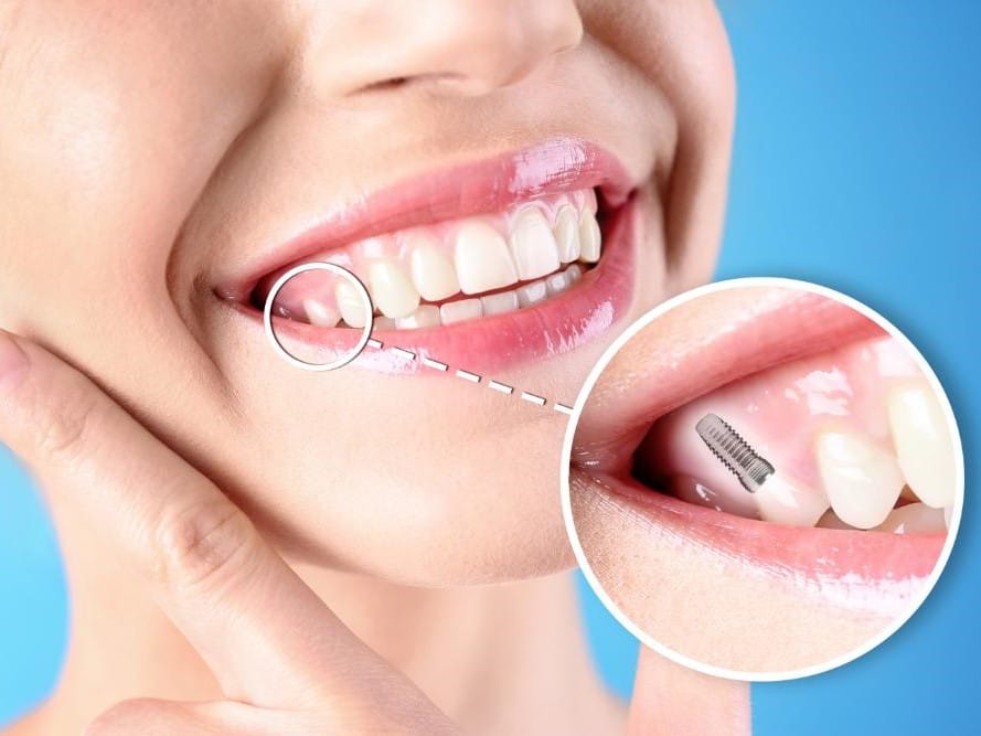 Smile With Dental Mini Implants