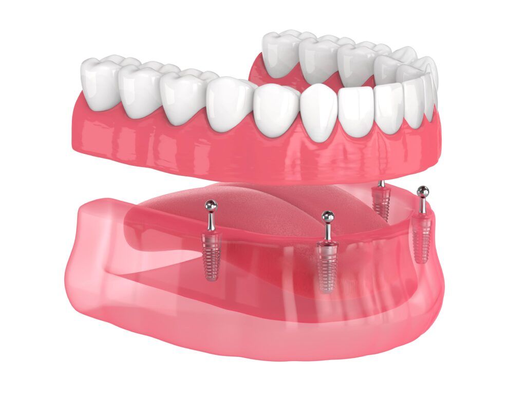 Dental Mini Implants for Full Arch Teeth Replacement
