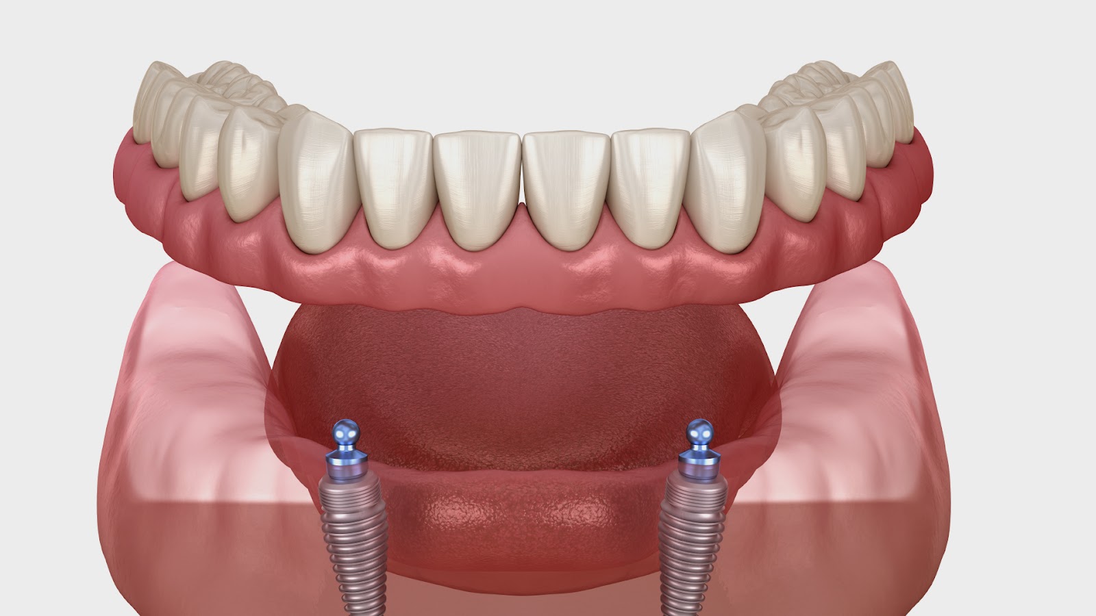 Dental Implants 3D modle