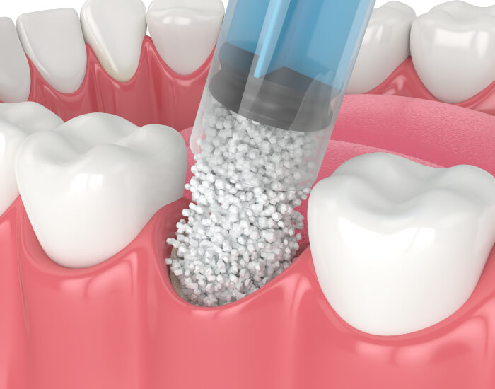 A Grafting Procedure Is Essential for Restoring Bone in the Jaw and Bone Growth.