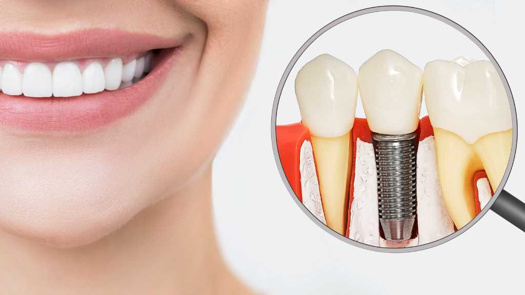 Model Showing Her Dental Implant on the Same Day