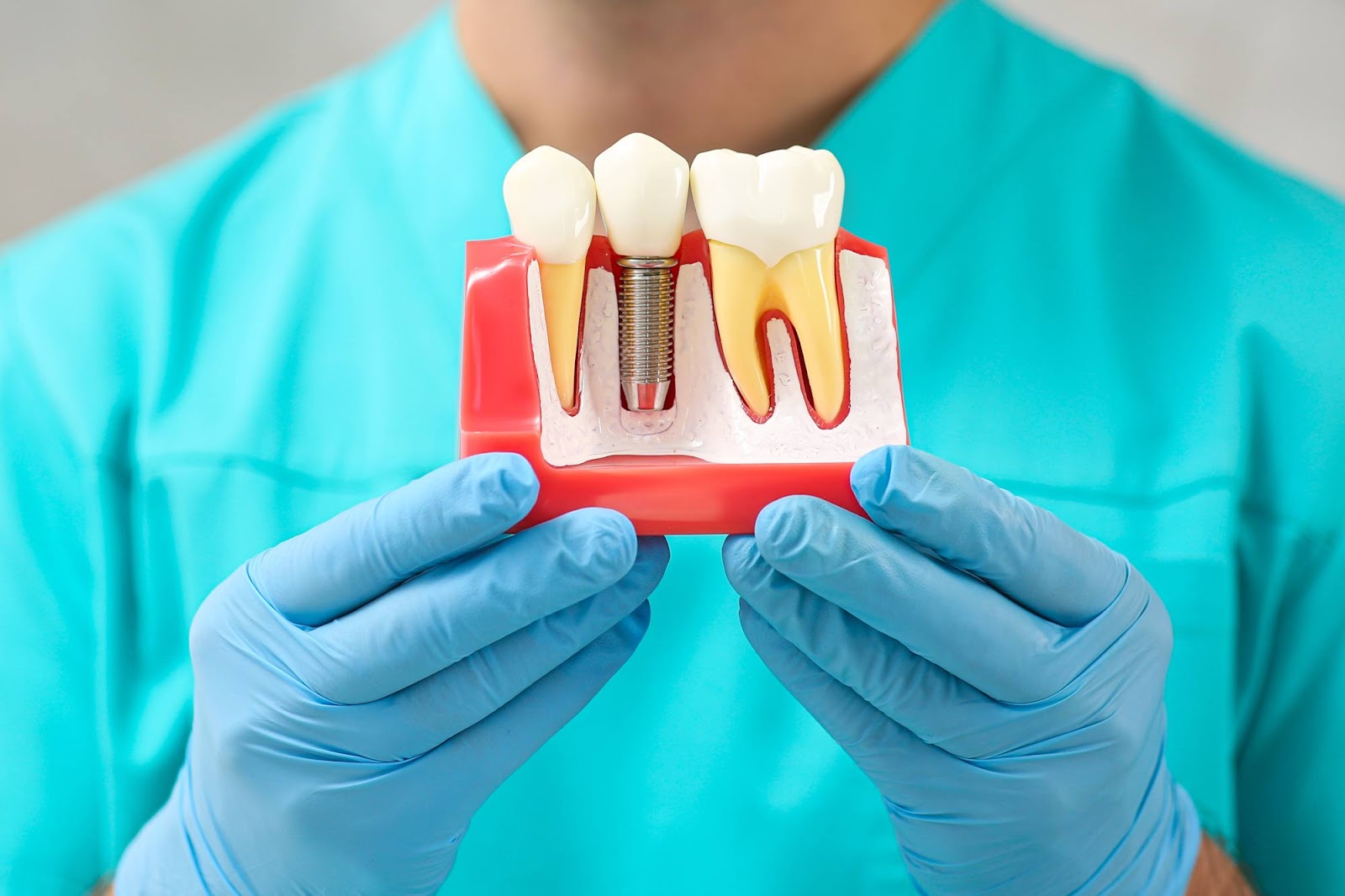 Same Dental Implant on Display to Show How to Get New Teeth Now