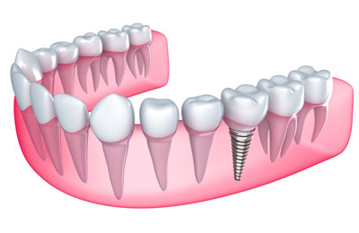An Artificial Jaw Showing How Real The Implanted Tooth Looks