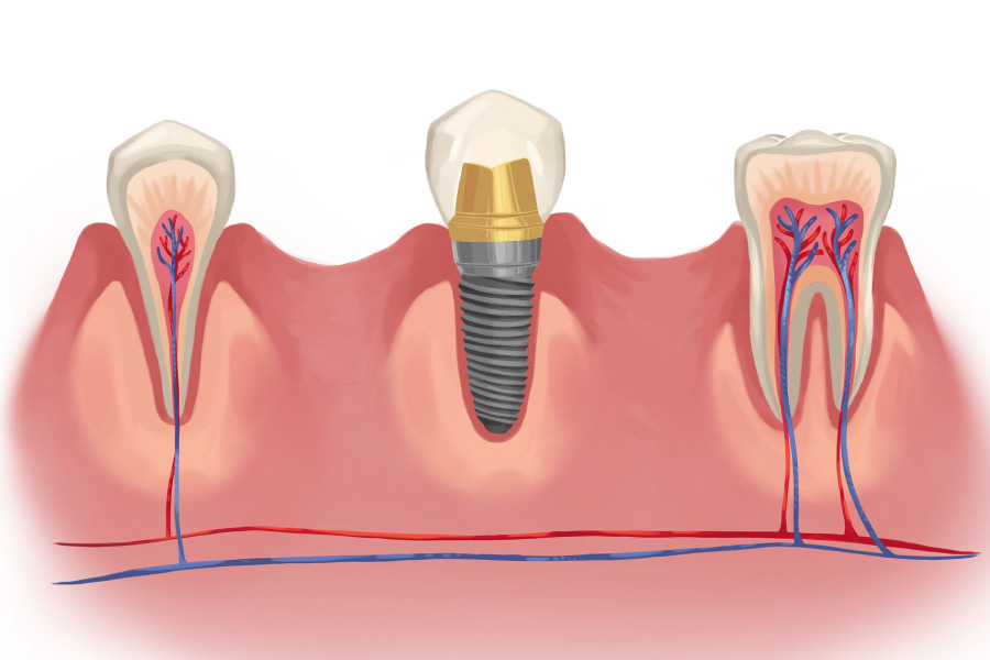 The Difference Between a Real Tooth and Implant Dental Teeth From Your Implant Dentists Near You at Mercer Island Dental