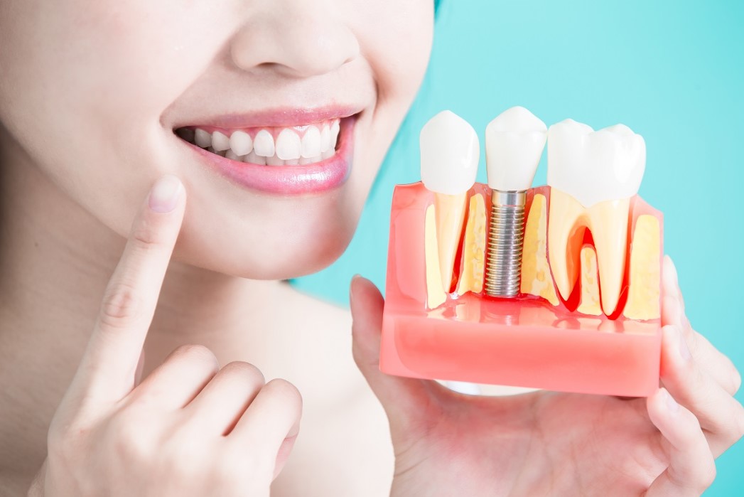 A Lady Showing Her Implant Dental Work From the Implant Dentists Near Her at Mercer Island Dental
