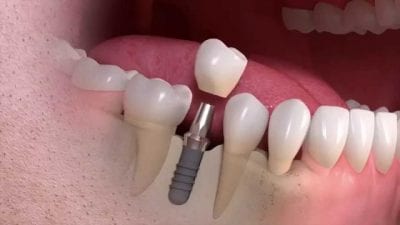 The Crown Placement of a Dental Implant Procedure