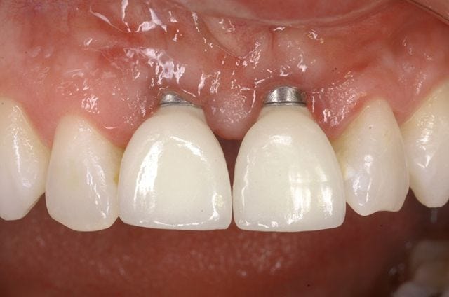 An Image Showing Risks With a Dental Implant Procedure