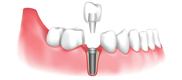 dental implants painful