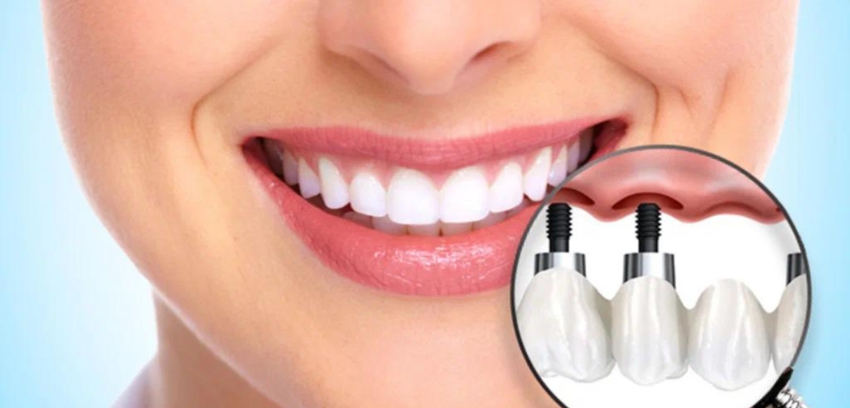 A Lady With Perfect Set of Teeth After Implant Dentistry