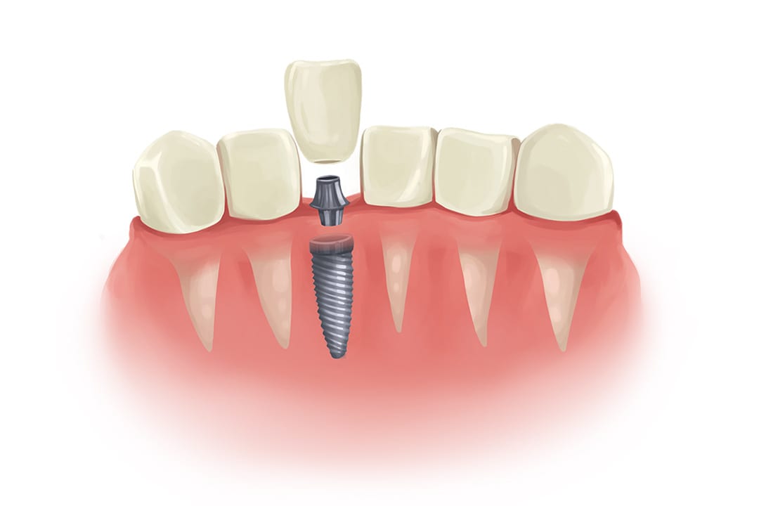 Showing How a Dental Implant Works