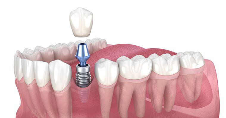 An Implant, an Abutment, and a Crown Being Placed Next to a Full Mouth of Teeth