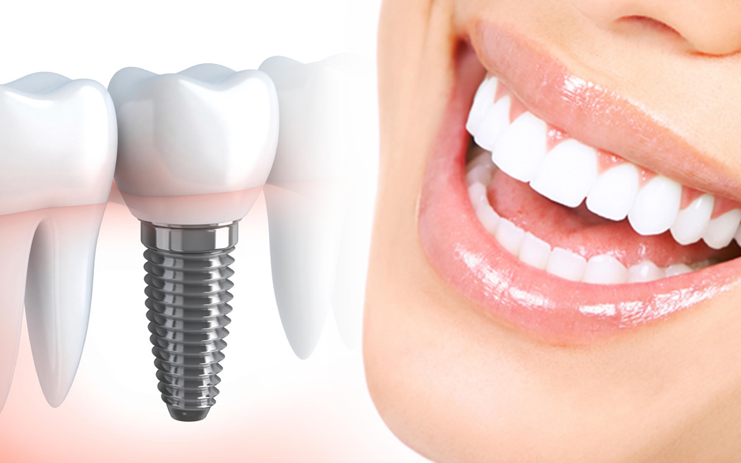 Implants Next to a Woman's Teeth to Show Comparison