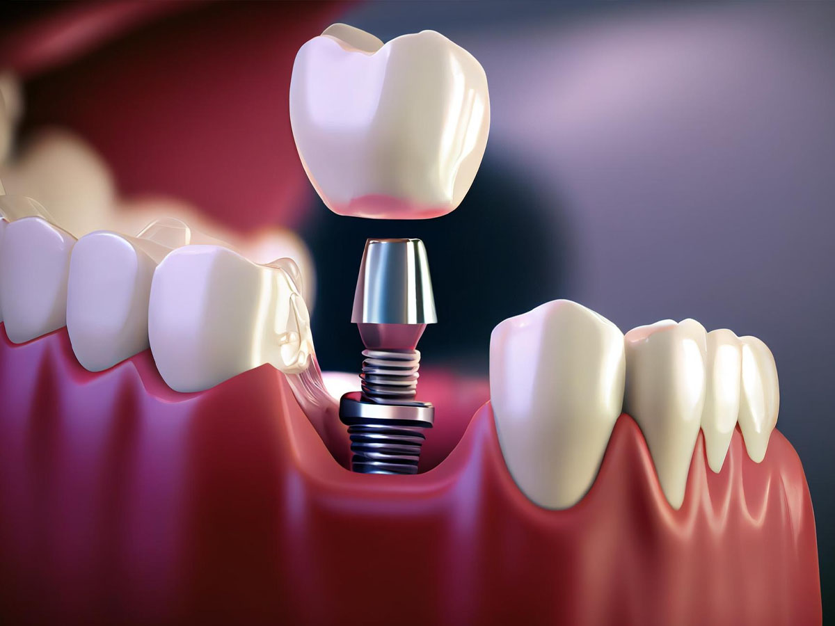 A Crown Being Placed onto an Abutment and Implant
