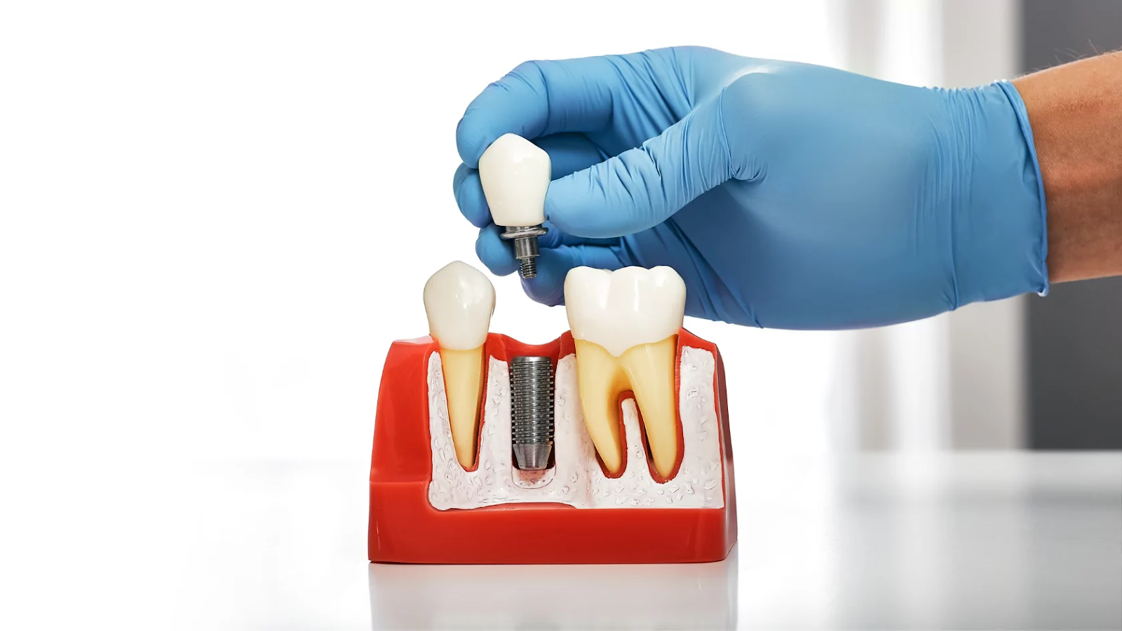 Placement of Implants (Dental) for Your Biting Strength