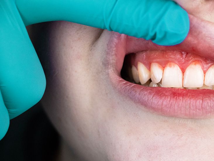 Dental exam revealing red, irritated gums—a symptom of gingivitis, periodontitis, and periodontal disease