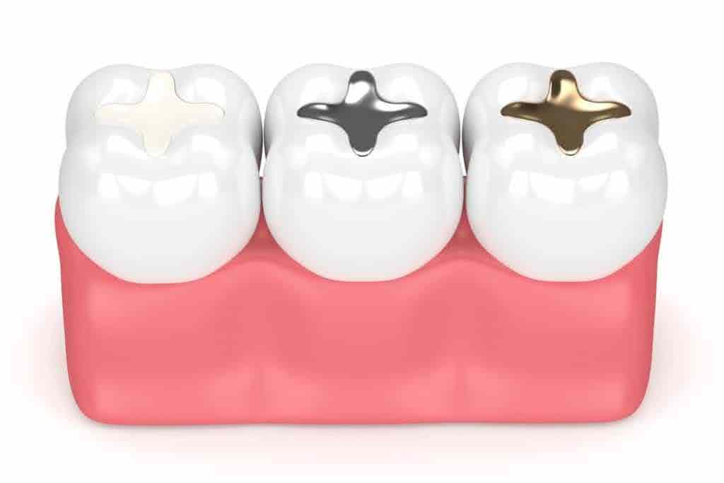Illustration of different types of tooth fillings, including dental bonding, silver, and gold fillings, showing how they fit into the teeth for restorative purposes