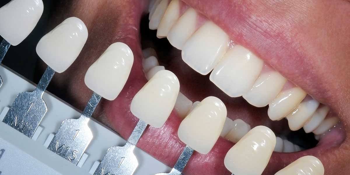 Close-up of a smile showing dental bonding, tooth fillings, and teeth bonding with color-matching veneers for a natural, radiant appearance.