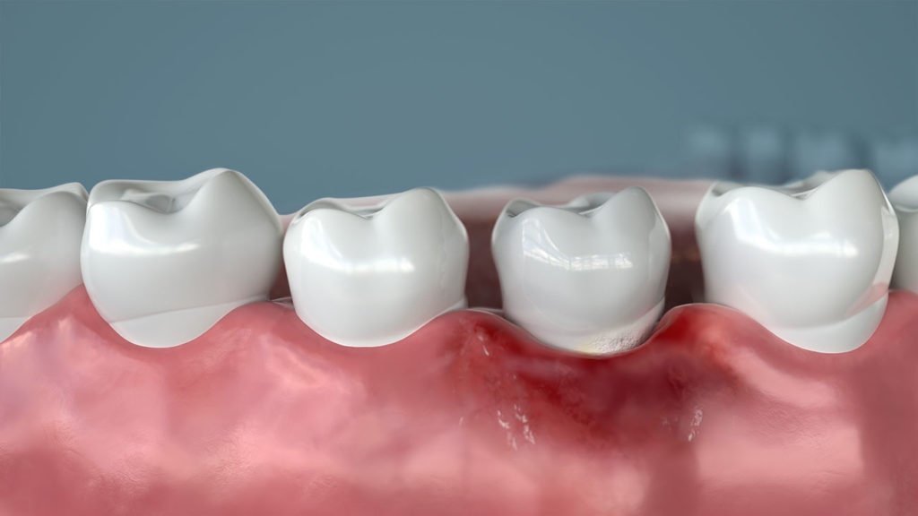 Gum disease can result in significant health complications