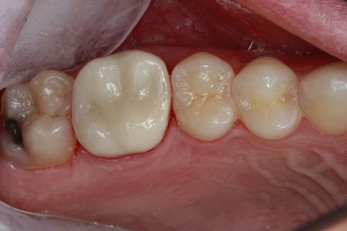 after of actual patient who got a dental crown