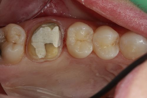 patient with filling