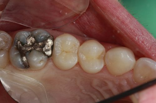 actual patient teeth before getting filling and crown