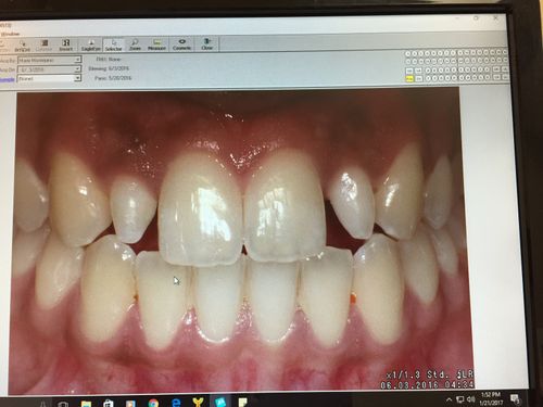 before of patient teeth before Fixing Peg Lateral