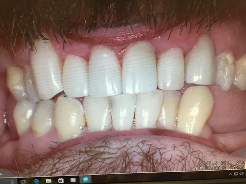 after of Hopeless decayed teeth and gums fixed with laser and composite