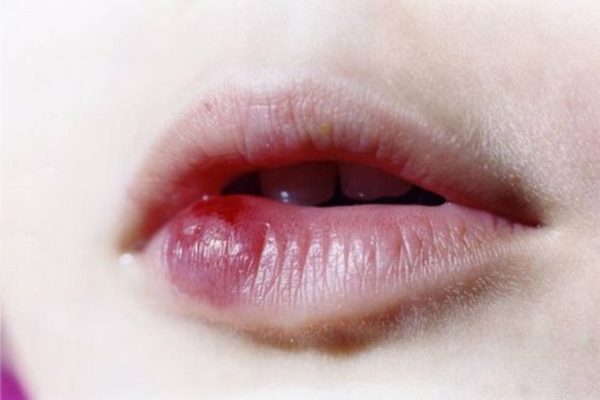Biến chứng tiêm filler