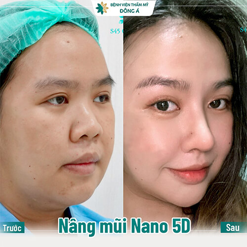 Địa chỉ nâng mũi S Line đẹp