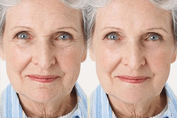 Yêu thích làm đẹp và trẻ hóa nhưng sợ phẫu thuật, bạn có thể lựa chọn botox