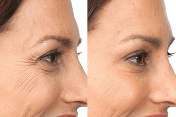 Tiêm thẩm mỹ giúp bạn lấy lại được vẻ đẹp và tự tin hơn