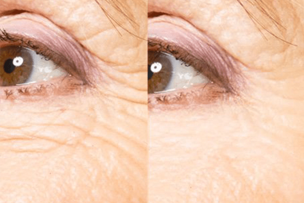 Tiêm Botox có thể xóa mờ nếp nhăn tĩnh