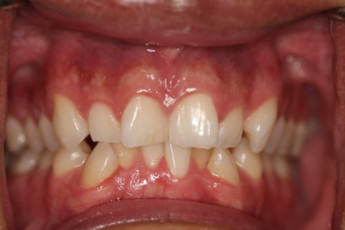 before image | Visit for cosmetic dentistry in Encinitas, CA.