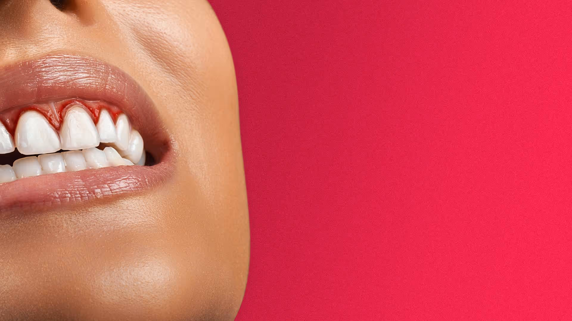 Gingivitis