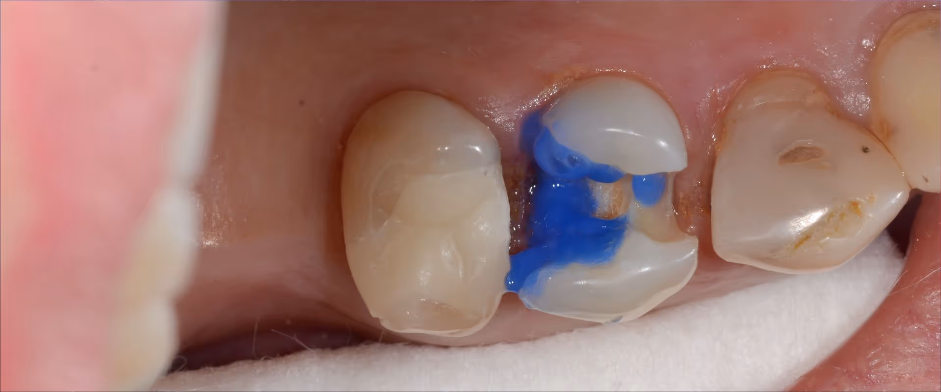 Versorgung tief subgingivaler Defekte mit Kompositrestaurationen