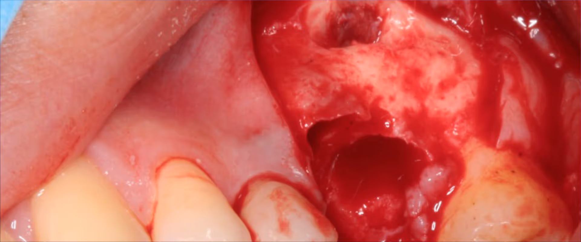 Zahnentfernung und Alveolenmanagement Teil 3/4