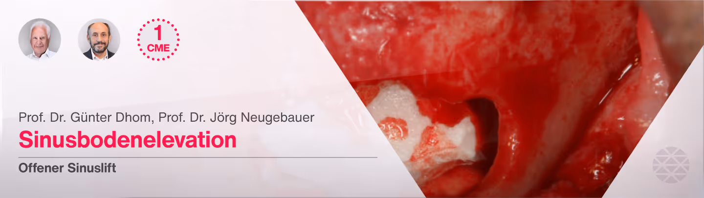 Sinusbodenelevation