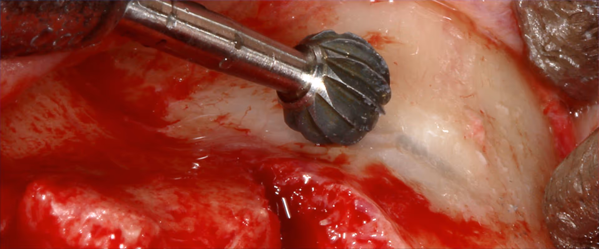Fotos und Videos bei oralchirurgischen Eingriffen