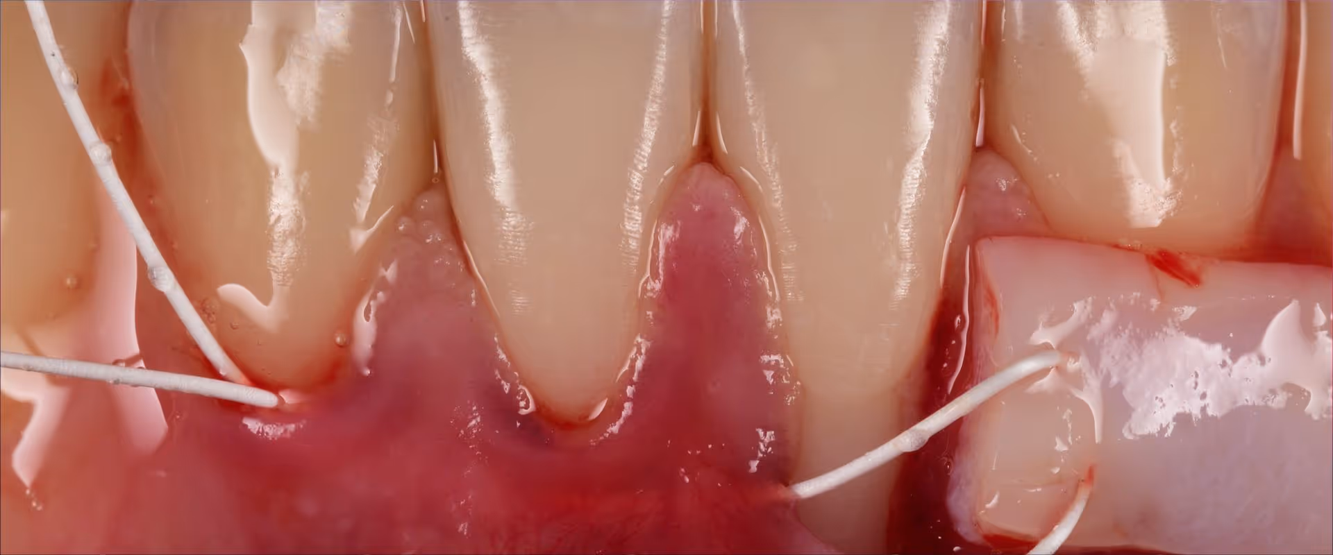 Weichgewebsaufbau um Implantate