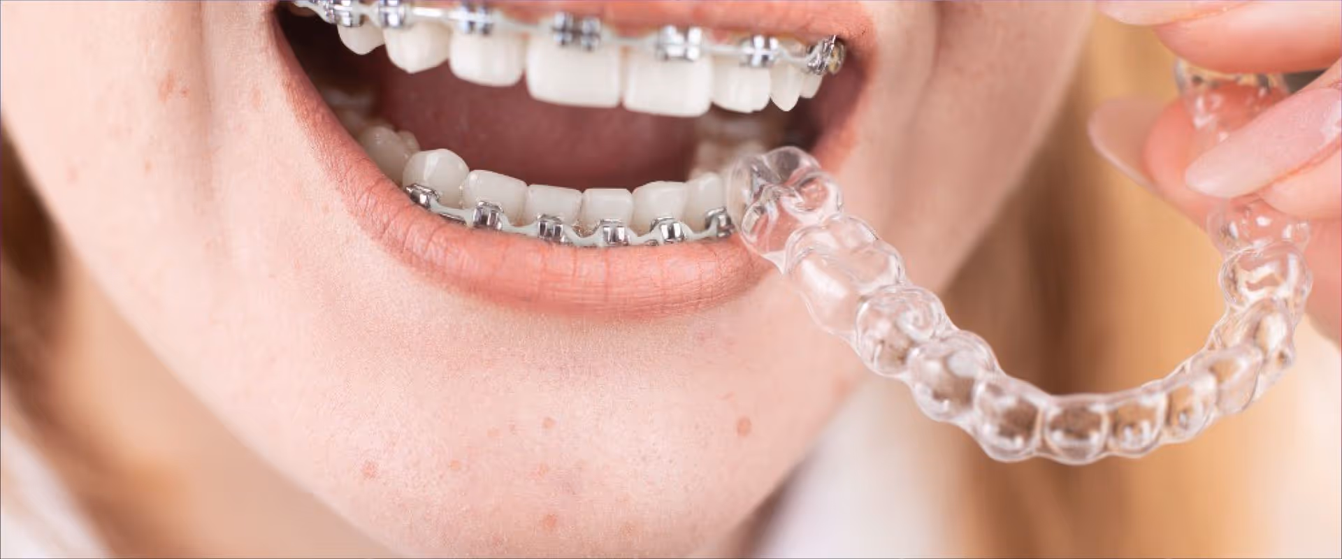 Wann sind feste Klammern (Brackets), Aligner und herausnehmbare Geräte im Vorteil?