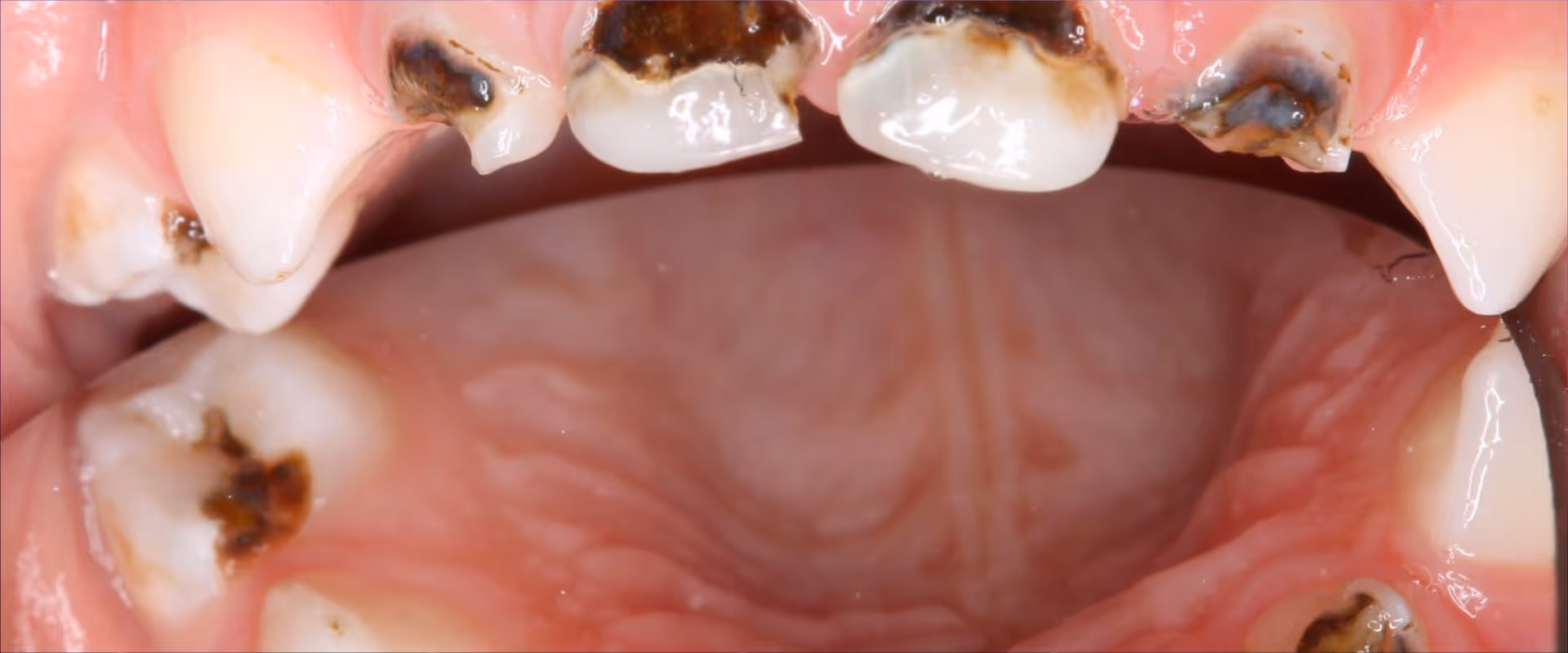 Silberdiaminfluorid (SDF)