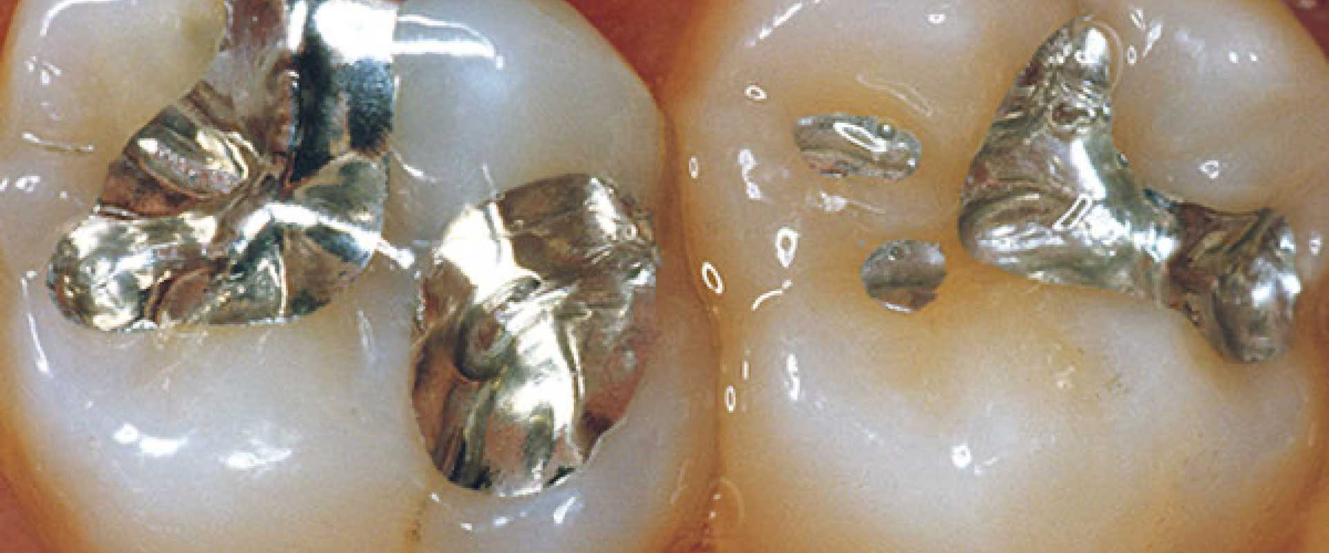 Amalgam adé - und wie weiter?
