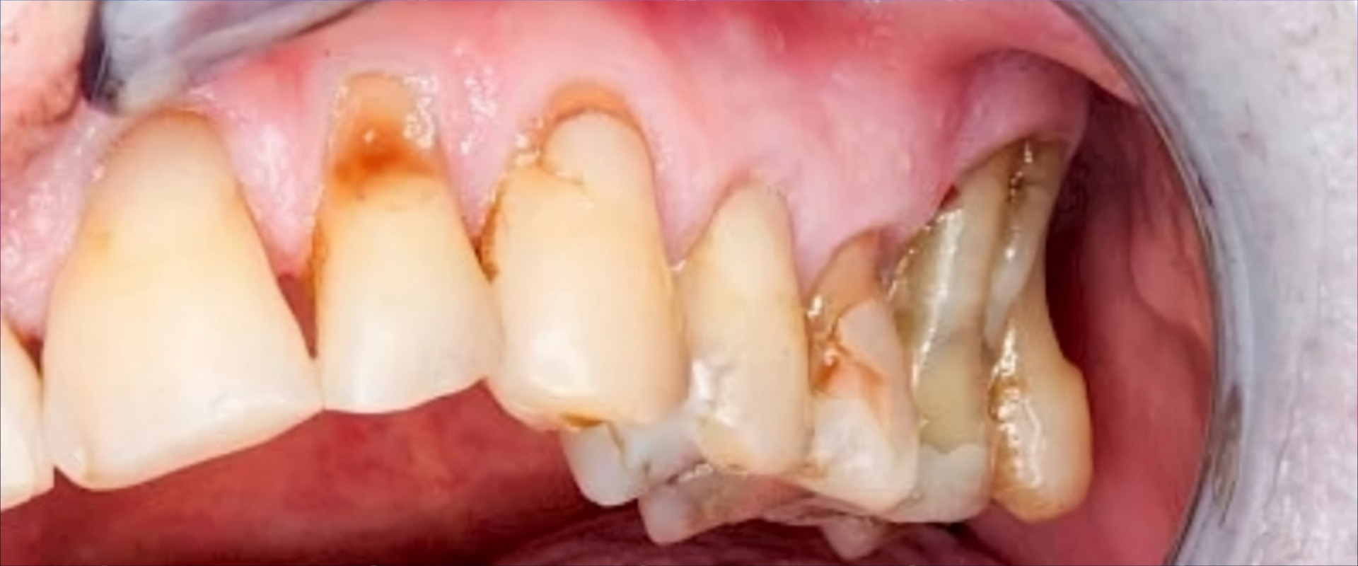 Risikoorientierte Prophylaxe