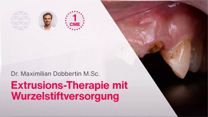 Extrusions-Therapie mit Wurzelstiftversorgung